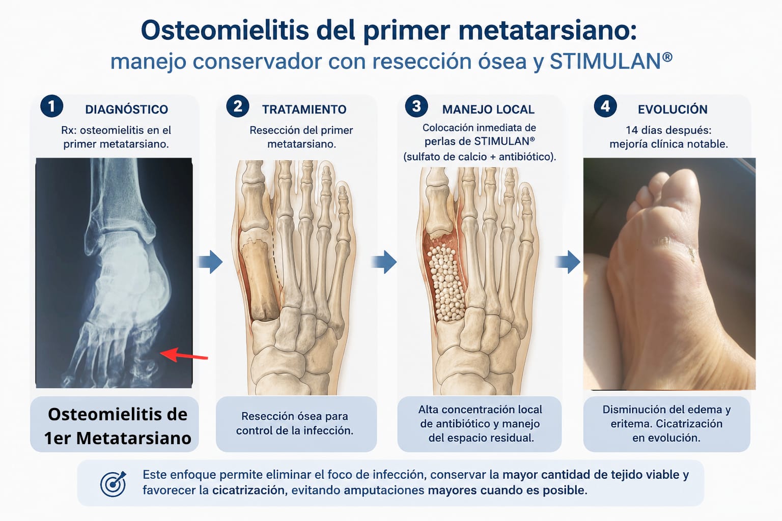 Secuencia de manejo conservador de osteomielitis del primer metatarsiano con resección ósea y perlas de Stimulan