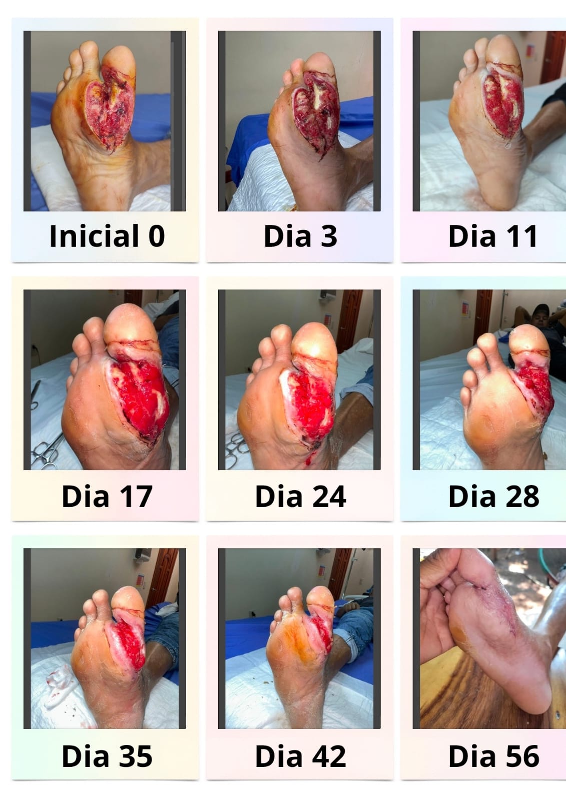 Secuencia fotográfica de la evolución de una herida plantar desde el día inicial hasta el día 56, con cicatrización progresiva