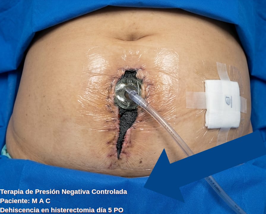 Caso clínico de terapia de presión negativa controlada en una dehiscencia de herida de histerectomía