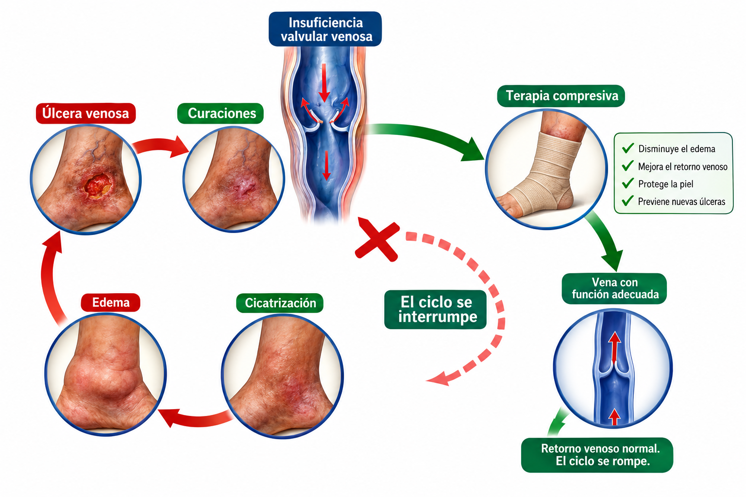 Ciclo de la úlcera venosa: úlcera, curaciones, cicatrización, edema y recurrencia, interrumpido por la terapia compresiva